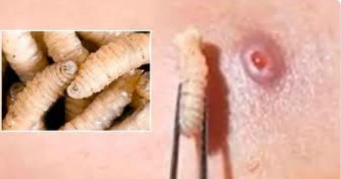 Informa SSY fallecimiento de paciente con diagnóstico de miasis asociada a gusano barrenador ; caso asociado a comorbilidades