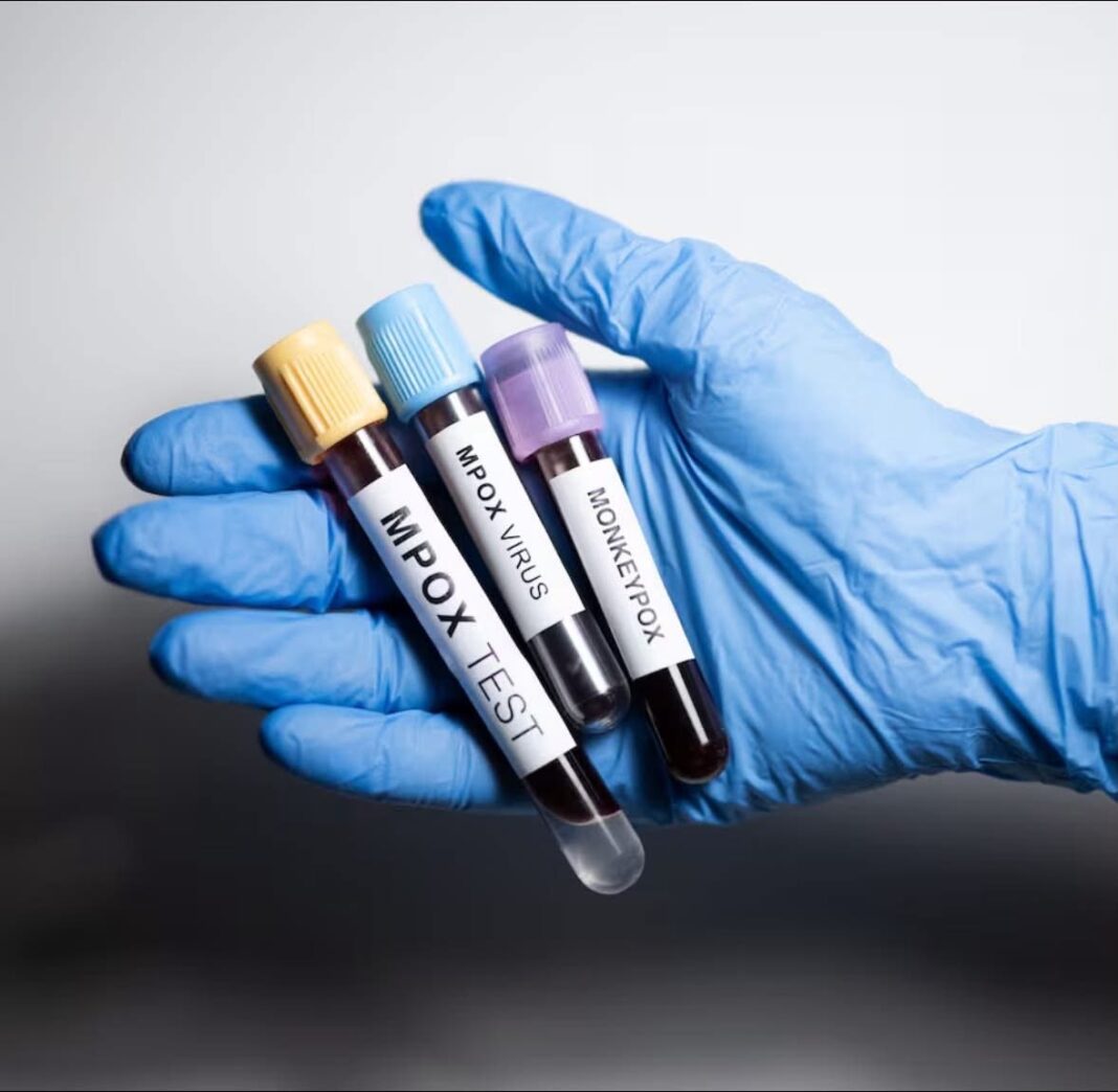 Yucatán confirma nuevos casos de Mpox y se mantiene como la segunda entidad con mayor incidencia en el país Yucatán confirma nuevos casos de Mpox y se mantiene como la segunda entidad con mayor incidencia en el país