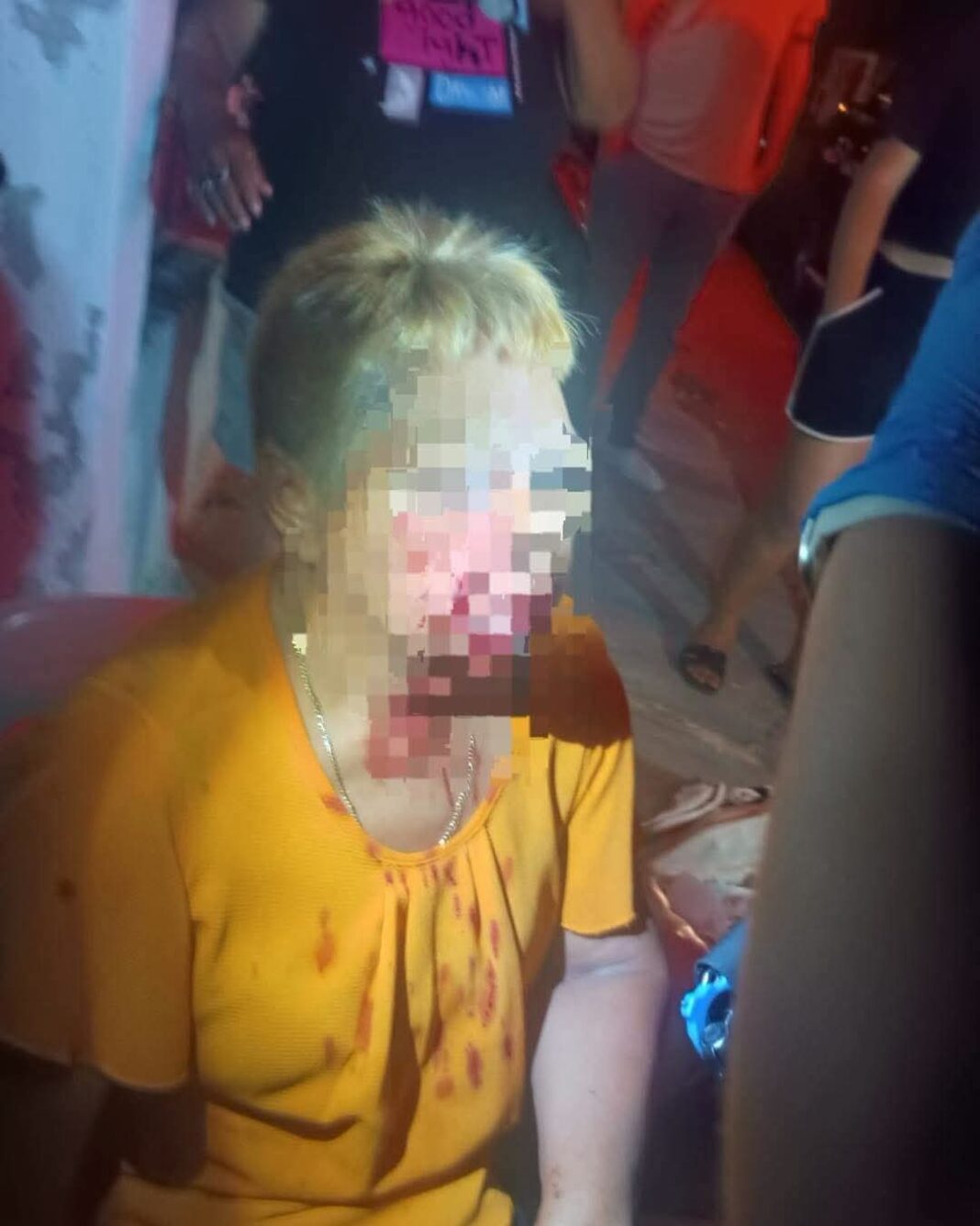 Dos perros pitbul atacan a mujer y le provocan heridas en rostro brazo y pierna Dos perros pitbul atacan a mujer y le provocan heridas en rostro brazo y pierna