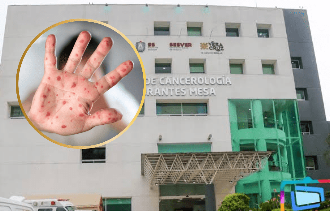 Brote de sarampión en centro oncológico de Veracruz suma 16 casos y dos muertos Brote de sarampión en centro oncológico de Veracruz suma 16 casos y dos muertos